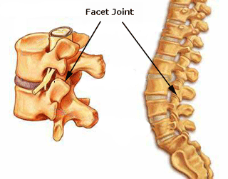 Low Back Pain and Facet Syndrome