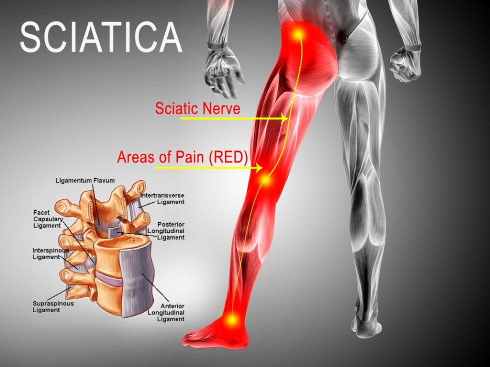 can-a-car-accident-cause-sciatica-dixie-chiropractic-st-george-utah